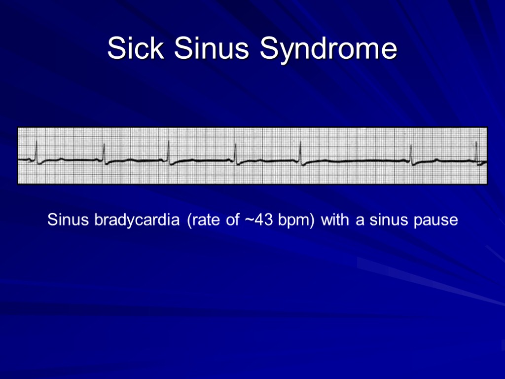 Sick Sinus Syndrome Sinus bradycardia (rate of ~43 bpm) with a sinus pause